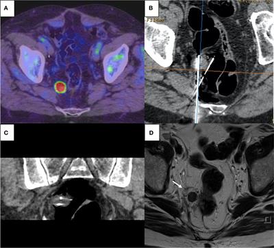 Single-Center Experience of Focal Thermo-Ablative Therapy After Pelvic Radiotherapy for In-Field Prostate Cancer Oligo-Recurrence